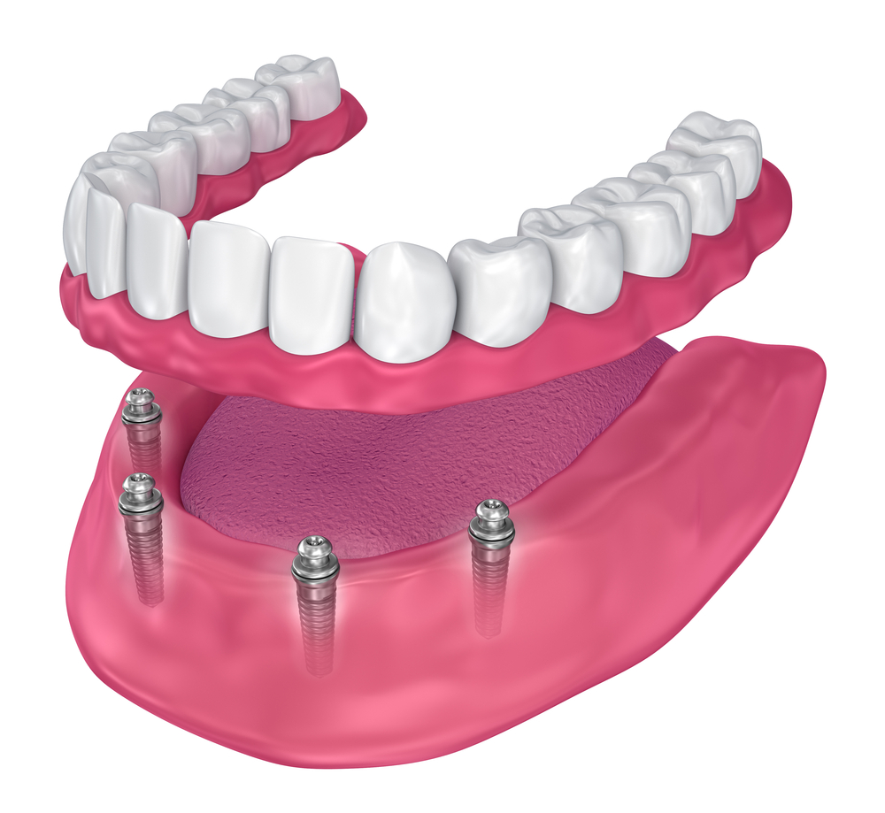 Overdenture,To,Be,Seated,On,Implants,-,Ball,Attachments.,3d